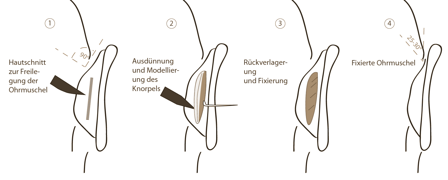 Ohrenkorrektur Rosenheim Ablauf - Dr. med. Florian Sandweg